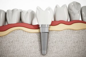 For Patients Who Are Missing One