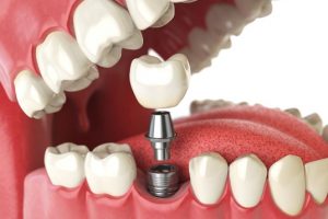 Most Implants Are Made Out Of Titanium
