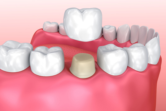 Why Might A Dental Crown Be Needed