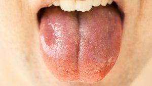 dry mouth